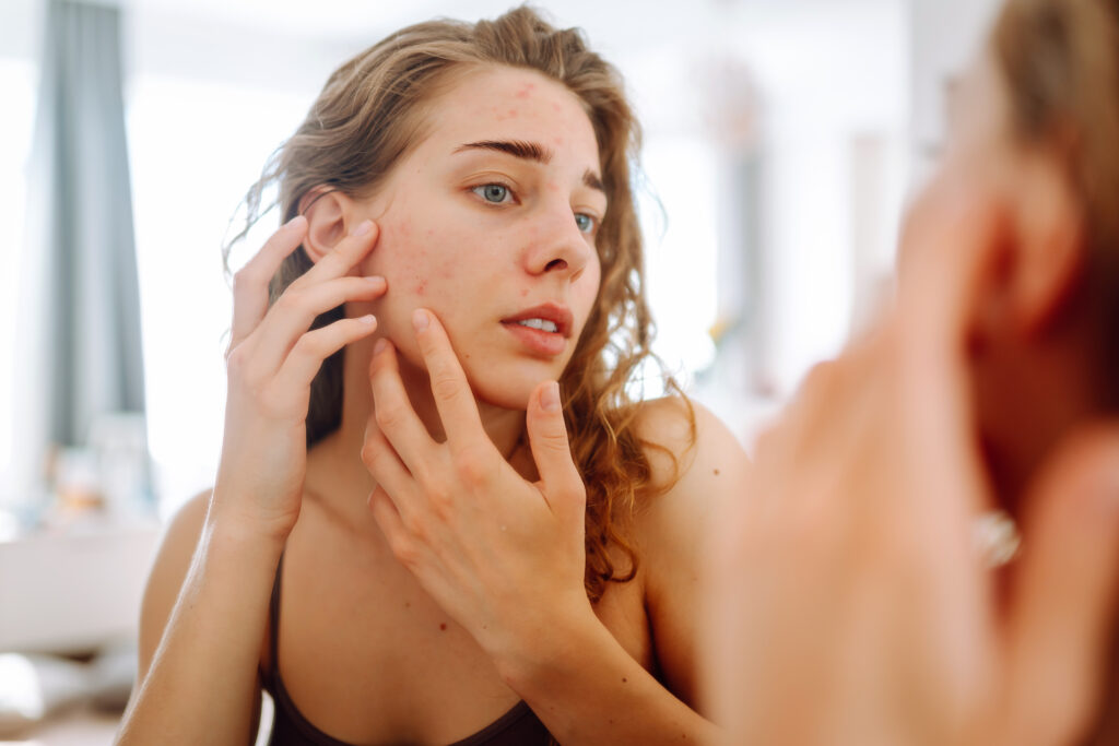 Woman examining acne in mirror