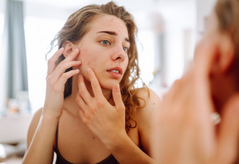 Woman examining acne in mirror